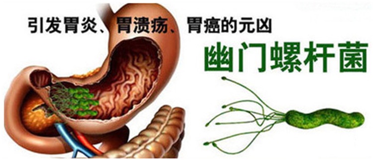  幽门螺旋杆菌感染，8亿国人游走在胃癌的边缘！一人感染传全家！